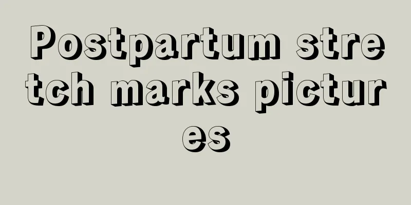 Postpartum stretch marks pictures