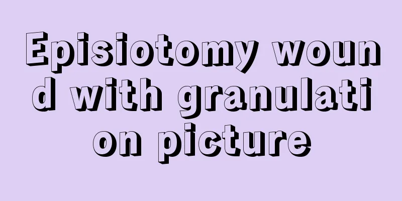 Episiotomy wound with granulation picture