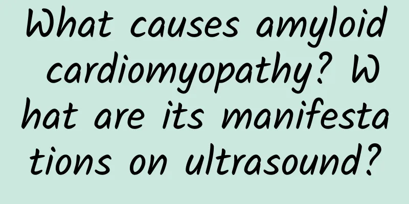 What causes amyloid cardiomyopathy? What are its manifestations on ultrasound?