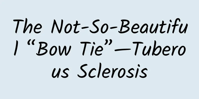 The Not-So-Beautiful “Bow Tie”—Tuberous Sclerosis