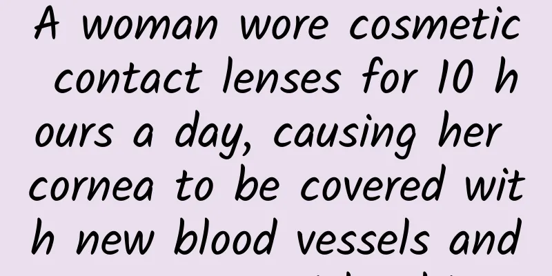 A woman wore cosmetic contact lenses for 10 hours a day, causing her cornea to be covered with new blood vessels and appear grayish white