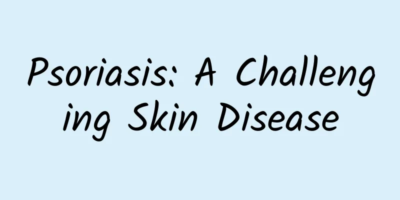 Psoriasis: A Challenging Skin Disease