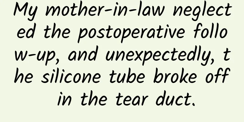 My mother-in-law neglected the postoperative follow-up, and unexpectedly, the silicone tube broke off in the tear duct.