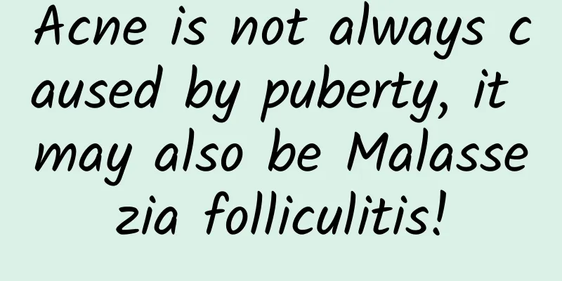 Acne is not always caused by puberty, it may also be Malassezia folliculitis!