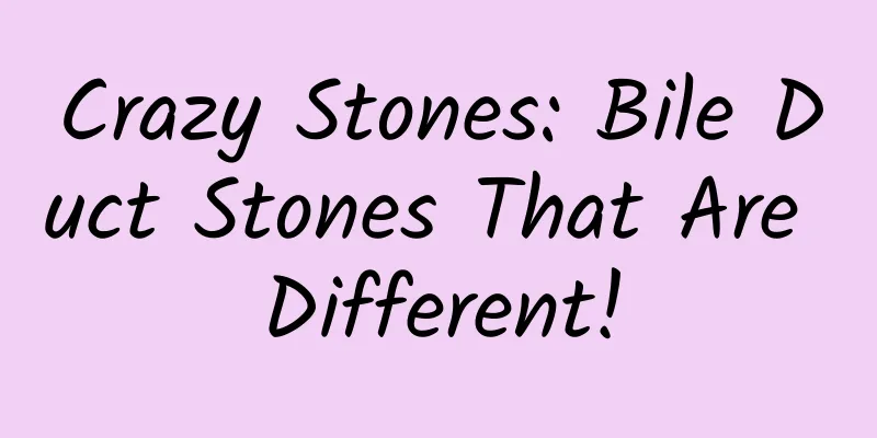 Crazy Stones: Bile Duct Stones That Are Different!
