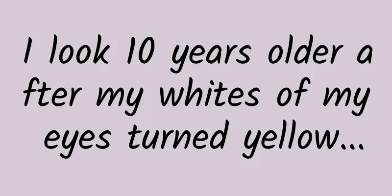 I look 10 years older after my whites of my eyes turned yellow...