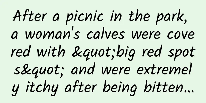 After a picnic in the park, a woman's calves were covered with "big red spots" and were extremely itchy after being bitten...